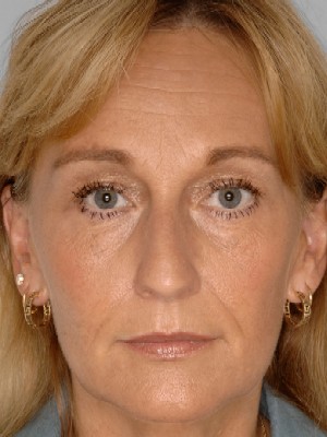 facial wrinkles